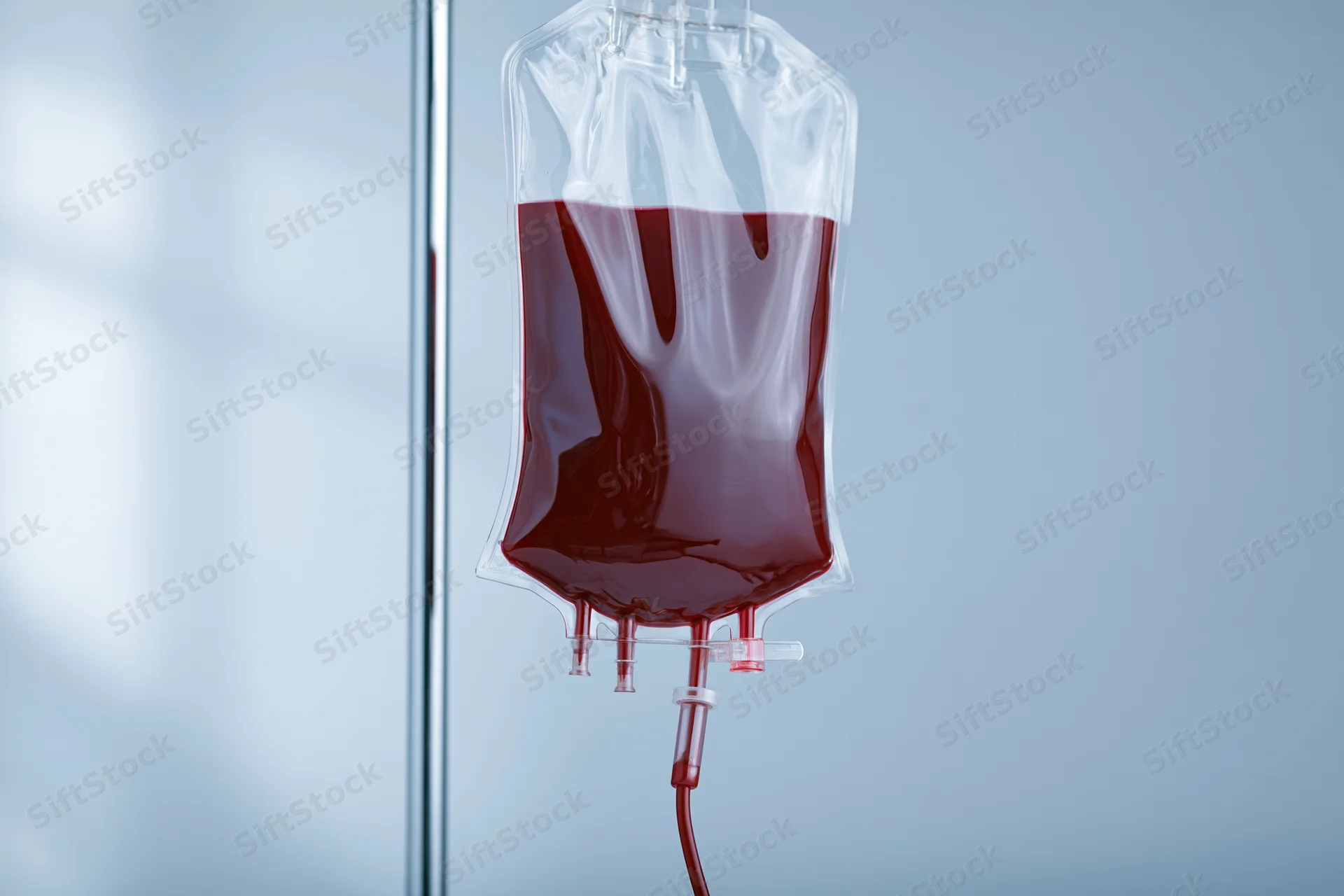 Blood transfusion bag hanging with dark red fluid connected to tubing in a clinical setting
