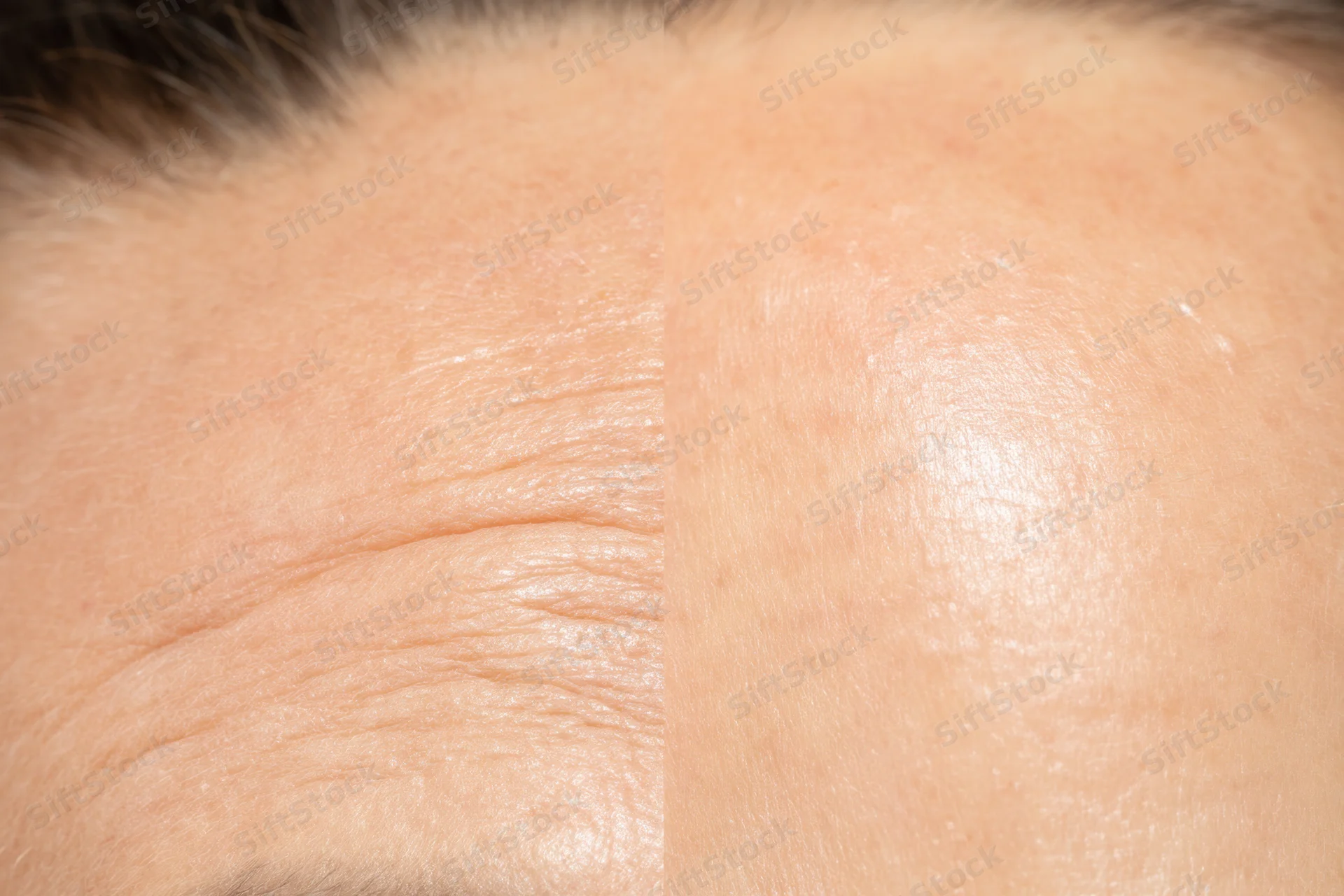 Split view of forehead showing wrinkles before and smooth skin after skincare treatment