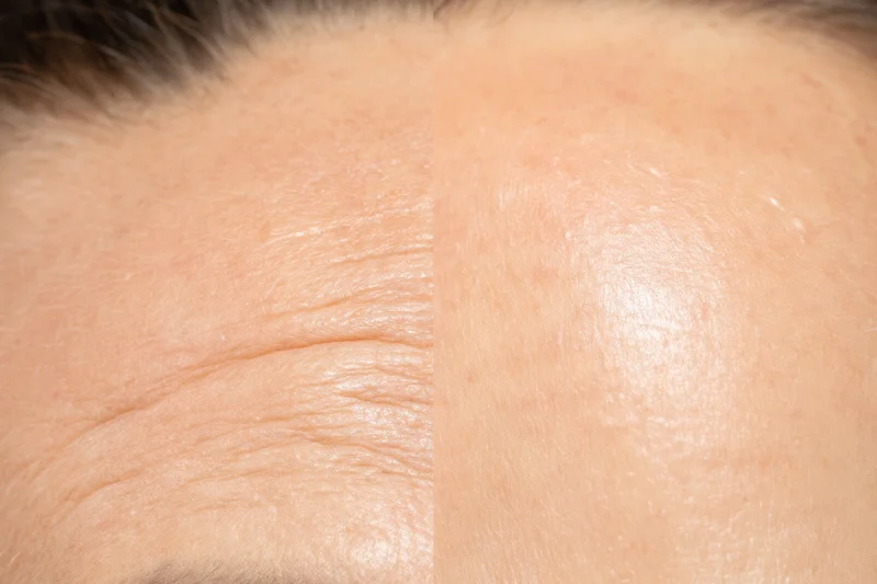 Split view of forehead showing wrinkles before and smooth skin after skincare treatment
