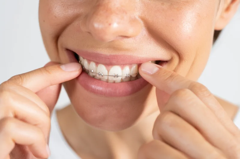 Woman adjusting metal braces on her teeth with fingers, close-up view