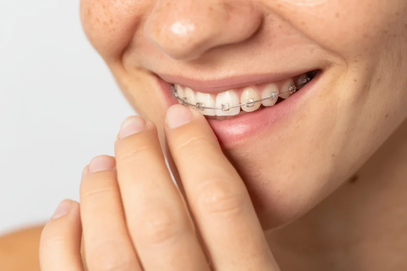Close-up of a woman smiling with braces, hand touching her lip