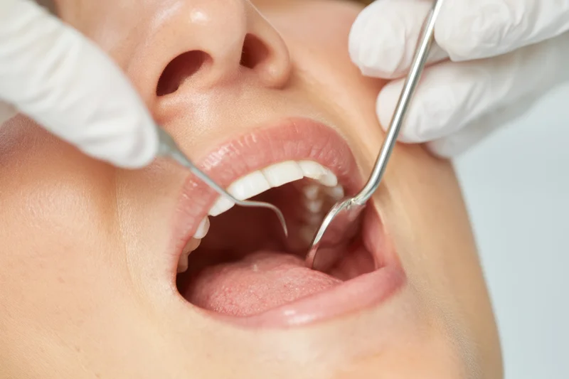 Closeup of a patient's open mouth during a dental examination with dental tools and gloves visible