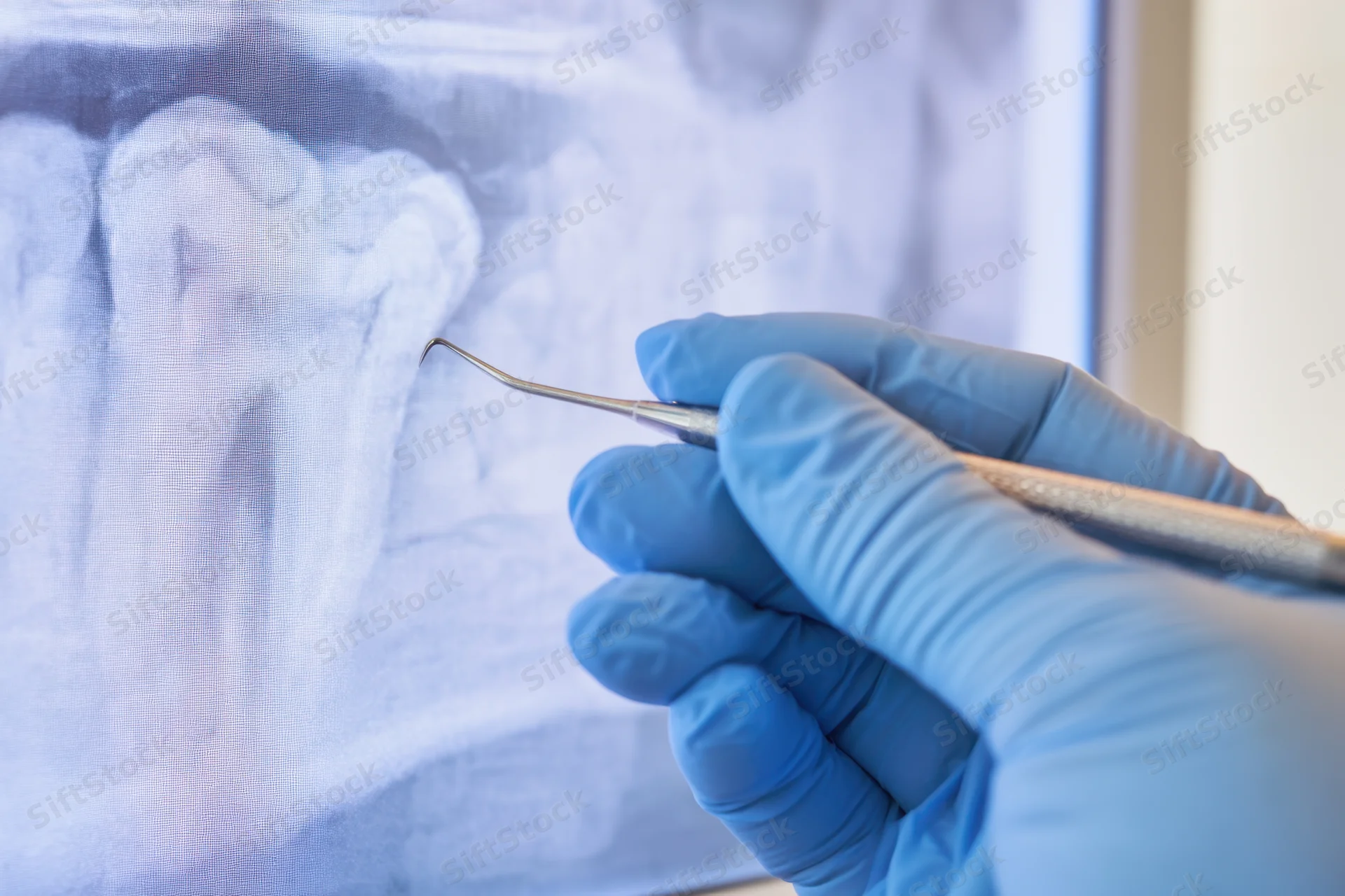Gloved hand holding dental probe pointing at tooth on xray screen in clinic