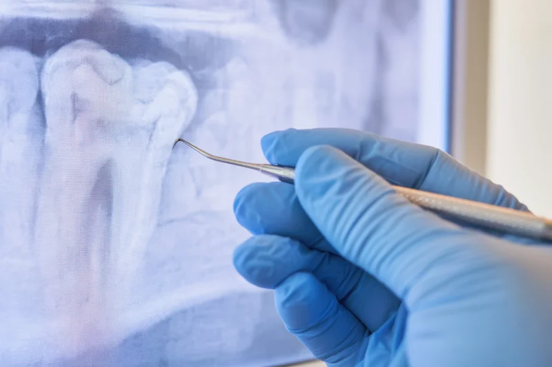 Gloved hand holding dental probe pointing at tooth on xray screen in clinic