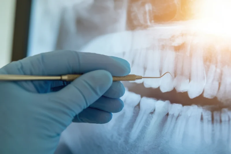 Dentist's gloved hand holding dental tool over dental xray of teeth