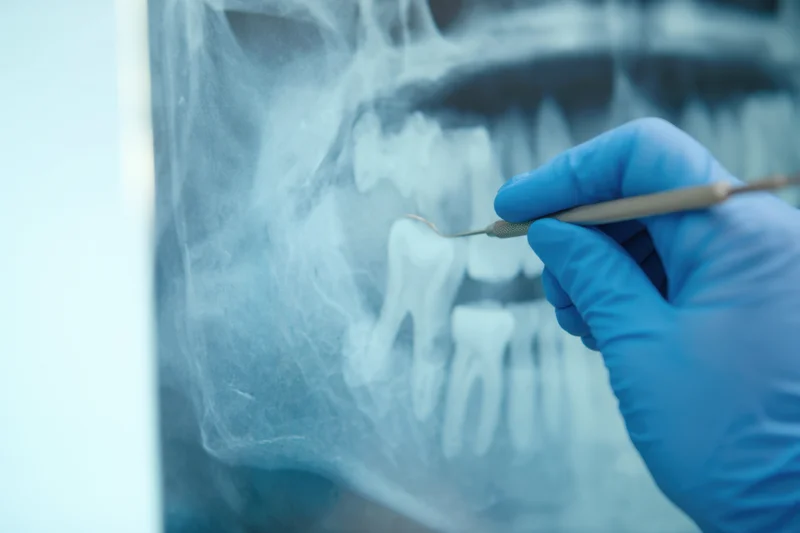 Dentist's gloved hand pointing to teeth on dental xray in clinic