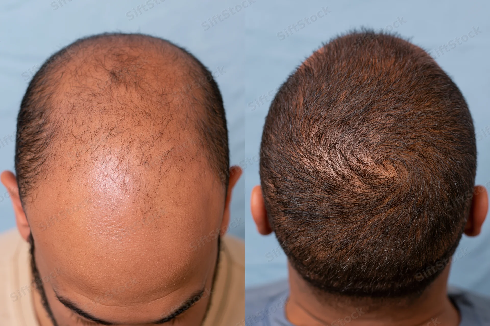 Before and after view of a man's scalp showing hair regrowth from treatment