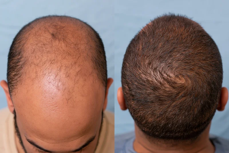 Before and after view of a man's scalp showing hair regrowth from treatment