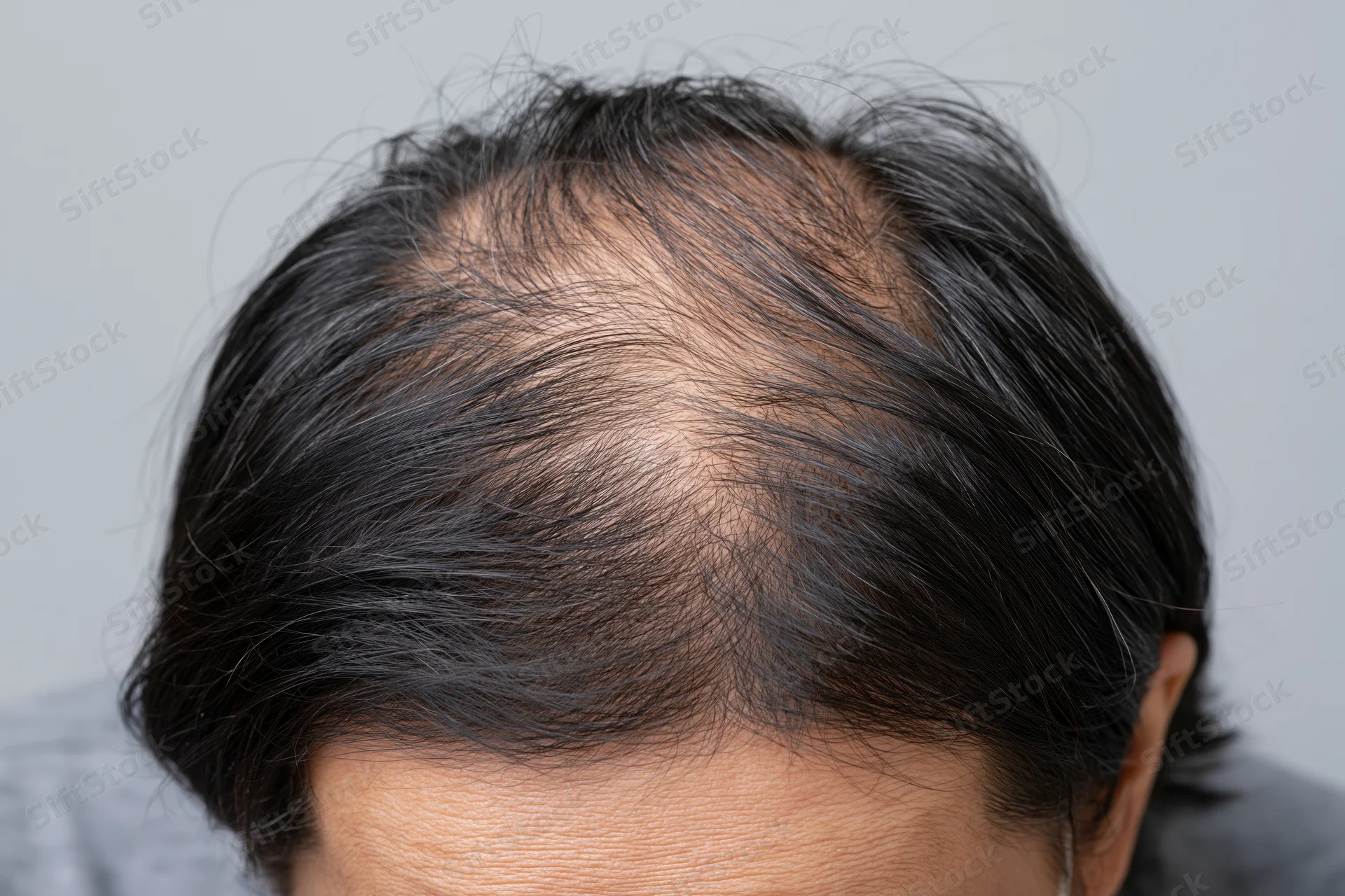 Close-up of a man's scalp showing hair thinning and balding at the crown