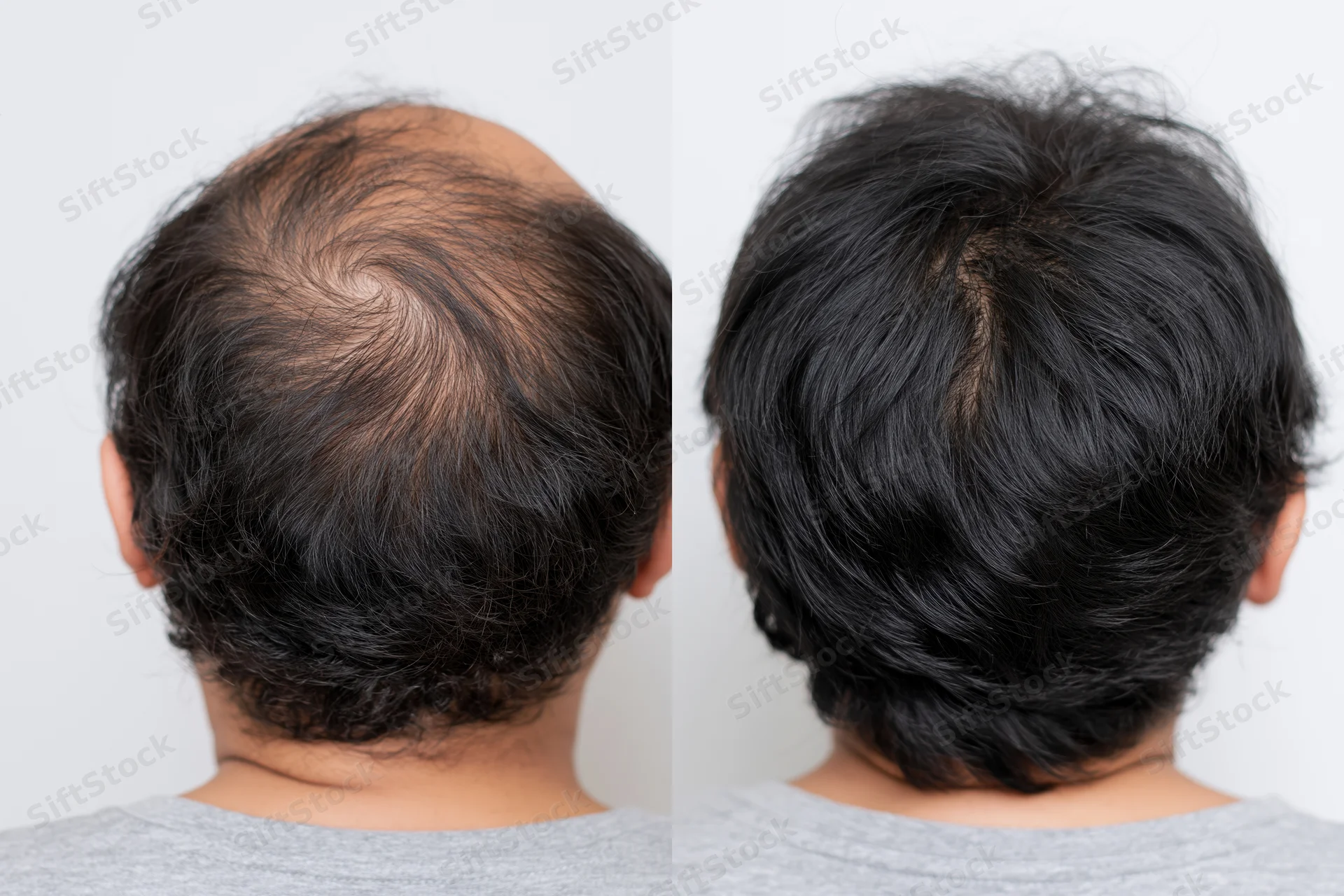 Back view of a man’s head showing hair thinning before and dense hair after treatment, isolated on white