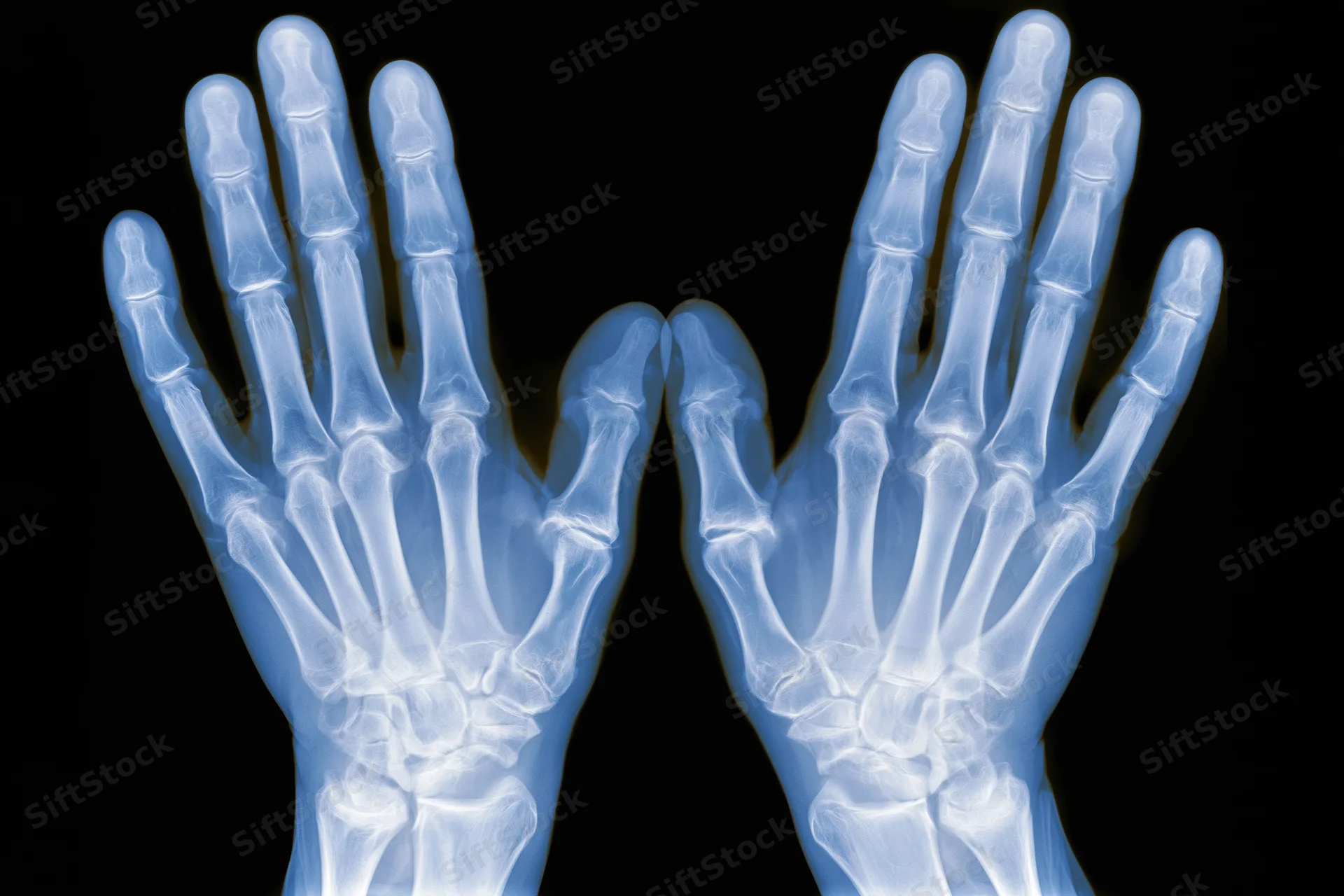 Bilateral xray of human hands showing bones and joints against black background