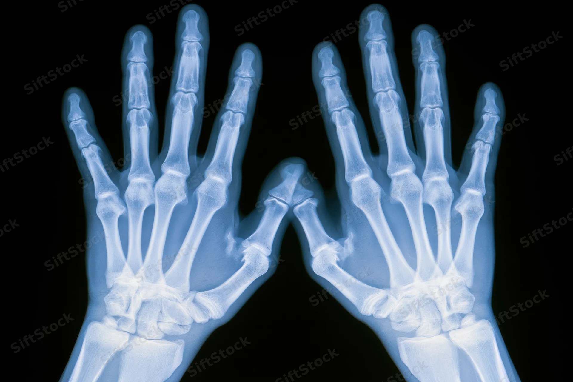 Bilateral xray of hands showing skeletal structure against black background