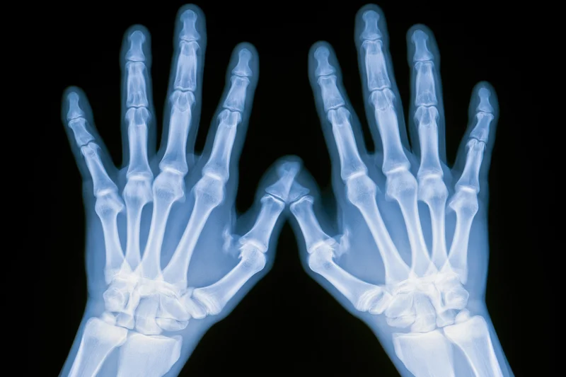 Bilateral xray of hands showing skeletal structure against black background