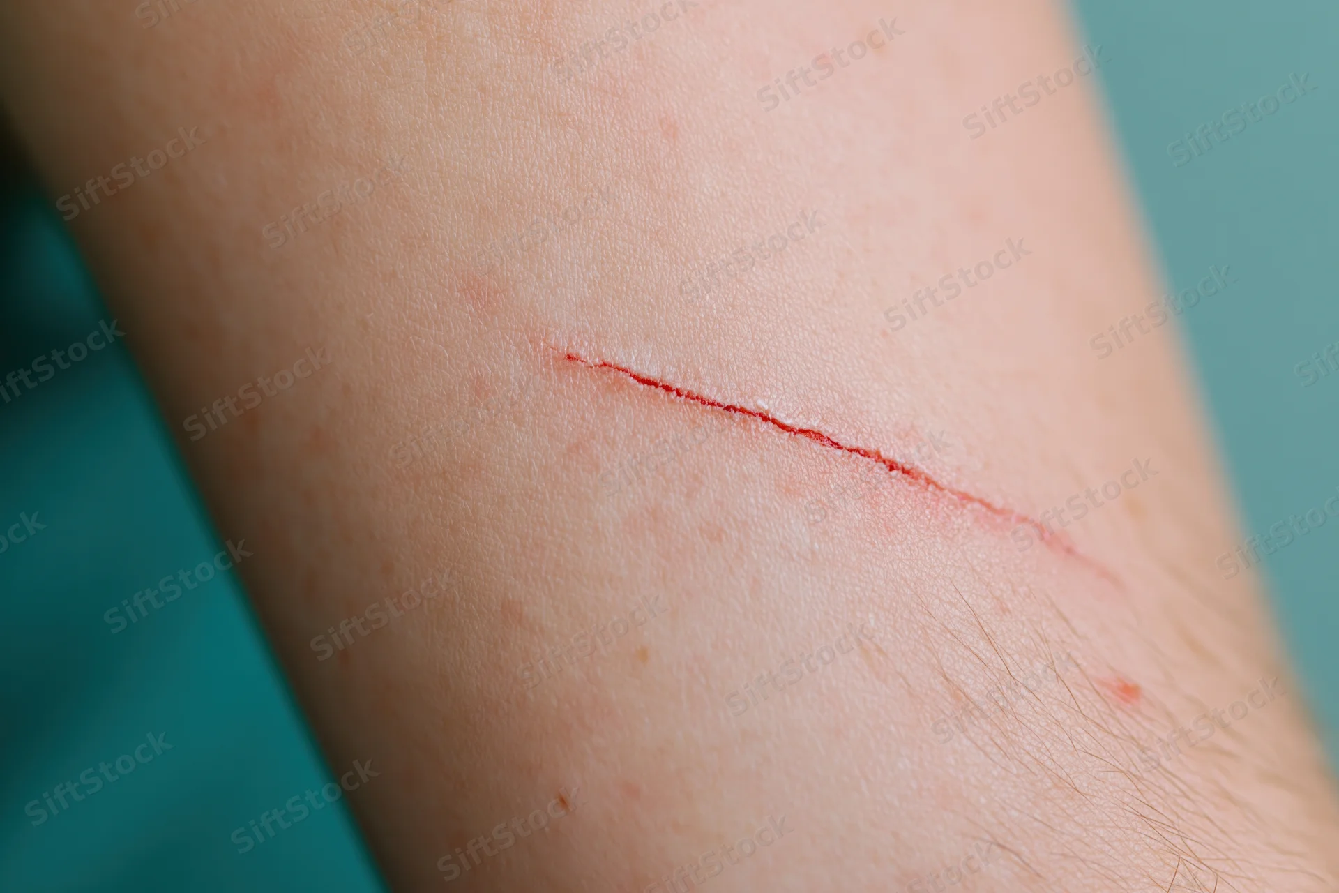 Close-up of a fresh shallow laceration on pale human forearm skin
