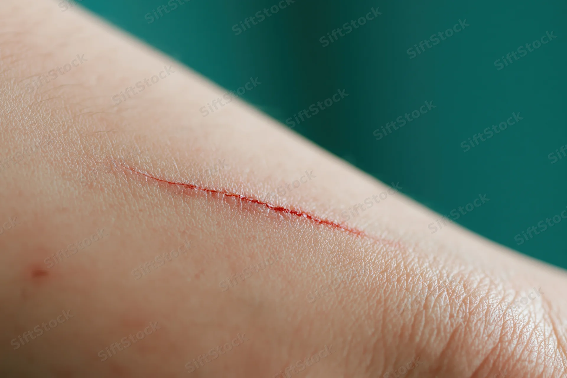 Close-up of a fresh shallow cut on pale human skin