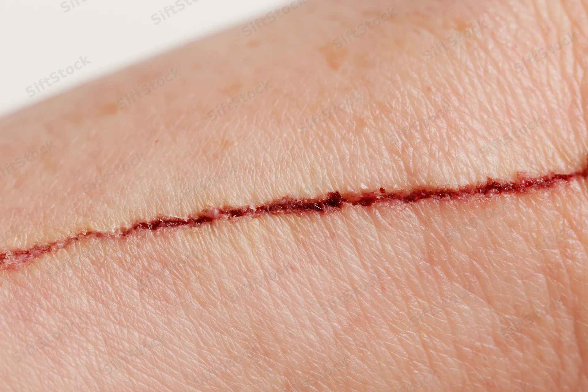 Close-up of a healing surgical incision on human skin