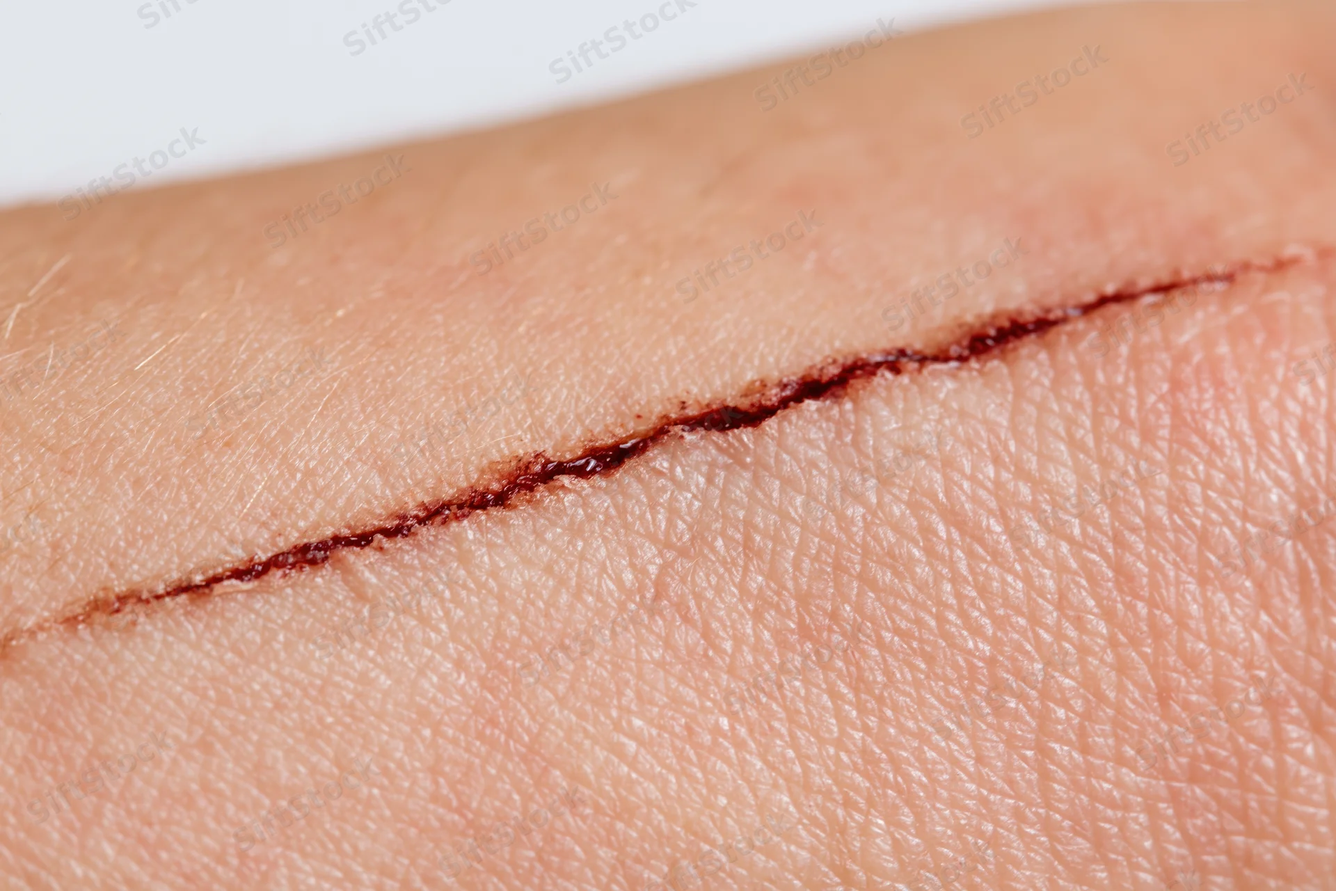 Close-up of a healing surgical incision on human skin