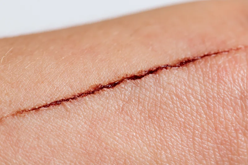 Close-up of a healing surgical incision on human skin