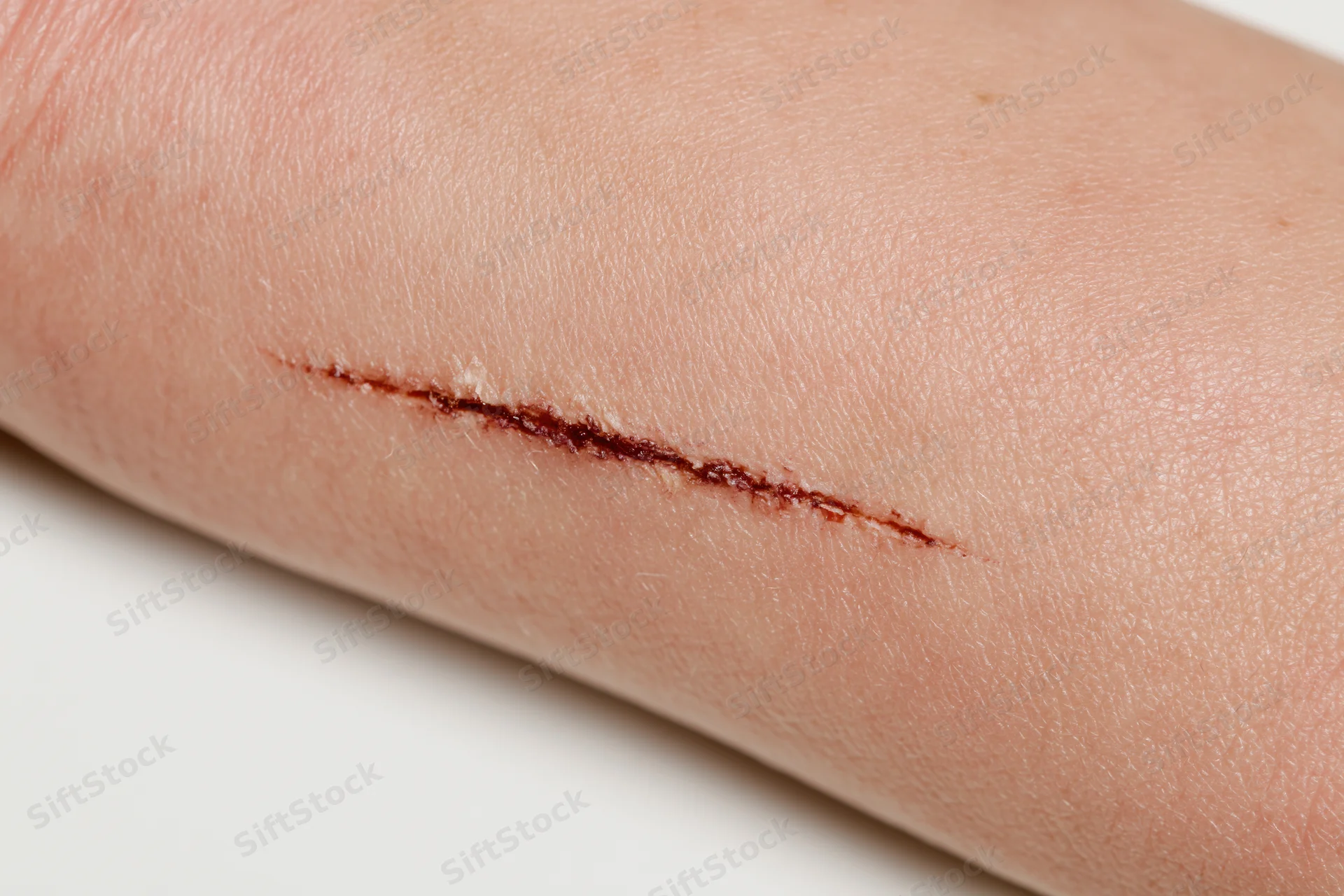 Close-up of a healing surgical incision on human skin
