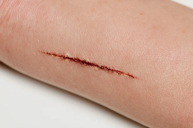 Close-up of a healing surgical incision on human skin