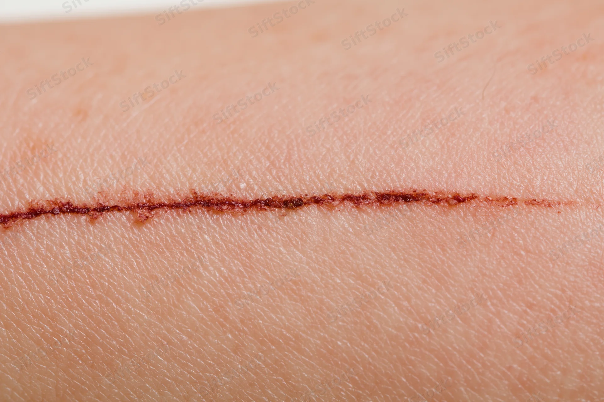 Close-up of a healing surgical incision on human skin