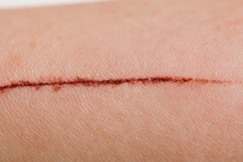 Close-up of a healing surgical incision on human skin