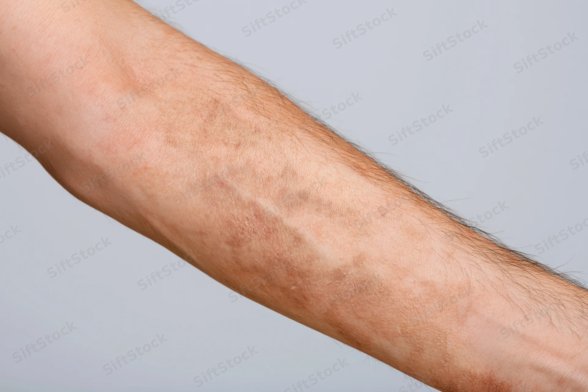 Close-up of a human forearm showing a burn scar with visible skin discoloration and texture changes