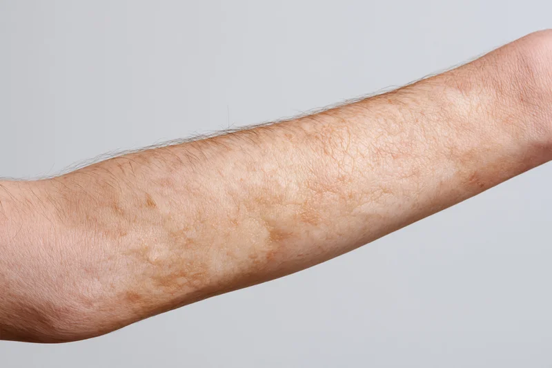 Close-up of a human forearm showing a burn scar with uneven skin texture and pigmentation against a neutral background