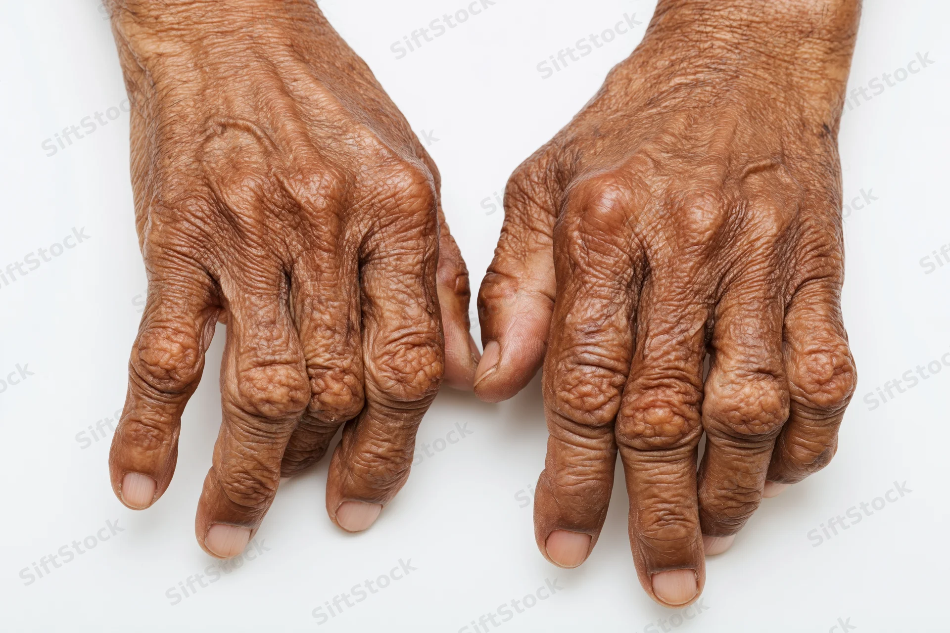 Elderly hands with joint deformities and wrinkled skin on white background