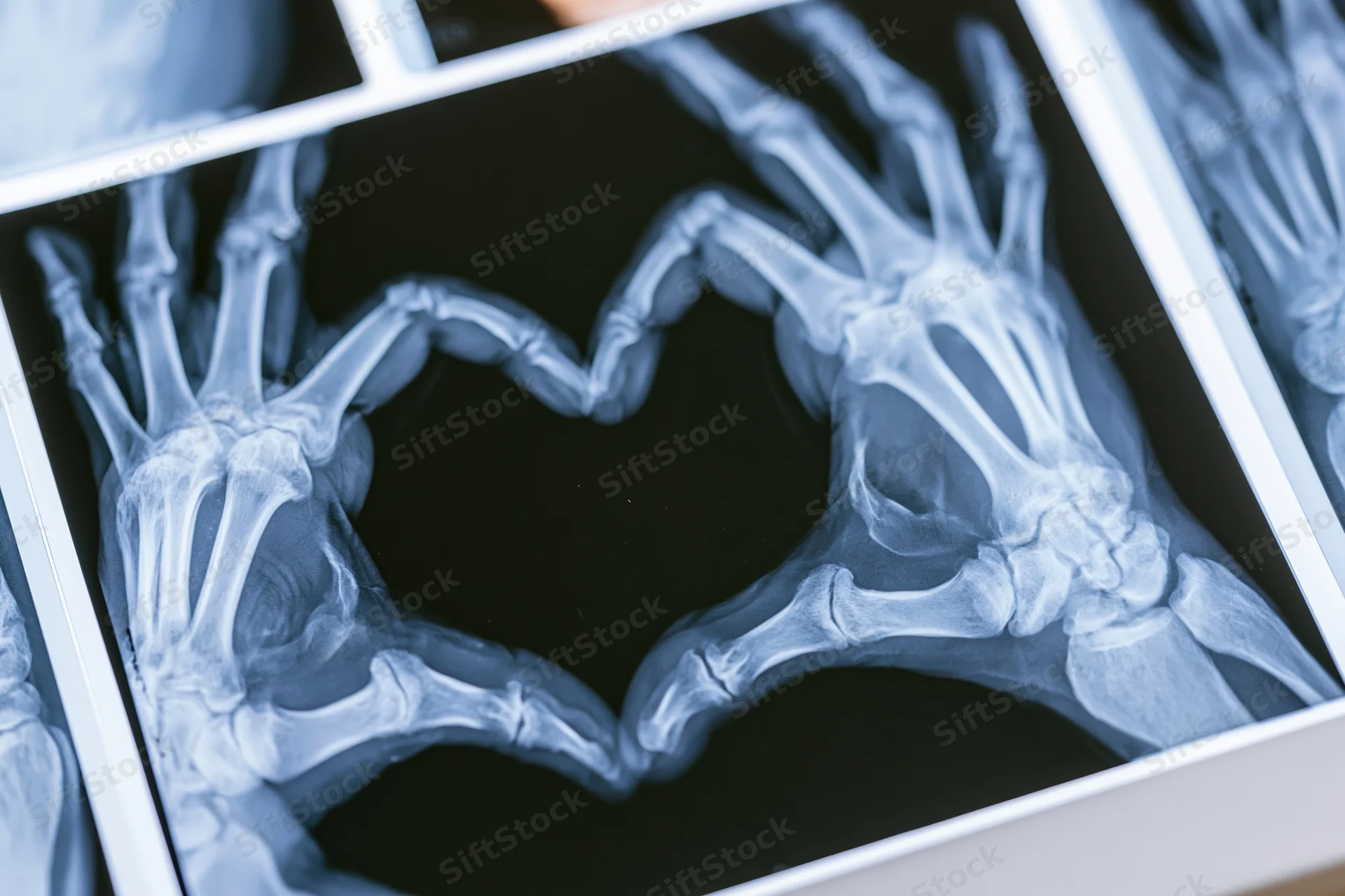 Xray of two hands forming a heart shape with visible bones and joints on a medical film