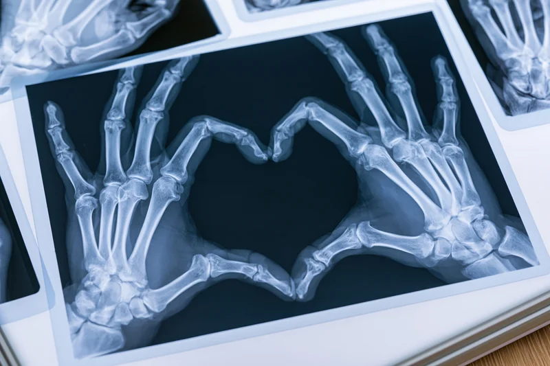 Xray of two hands forming a heart shape with visible bones and joints on film