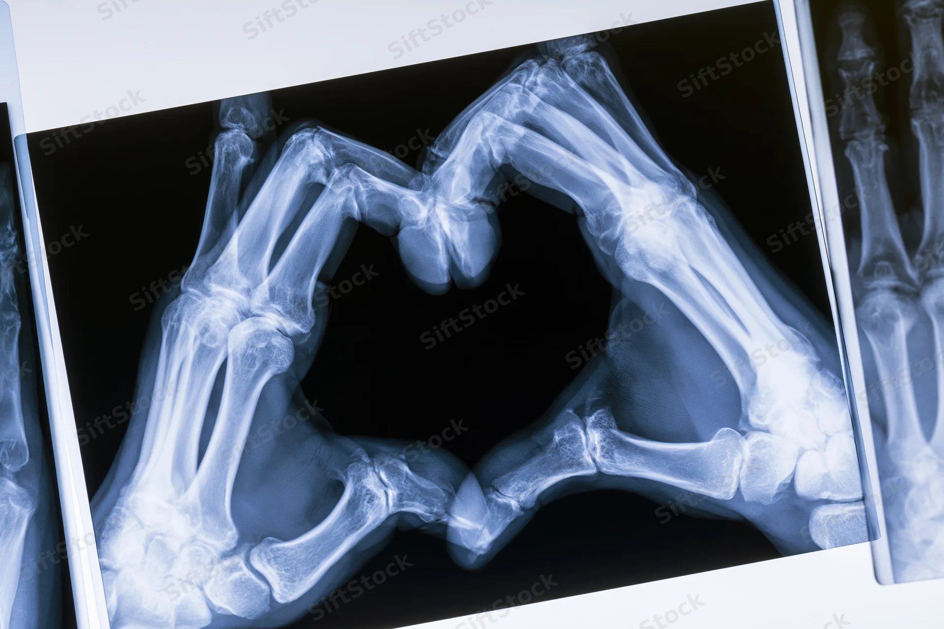 Xray of two hands forming a heart shape with fingers