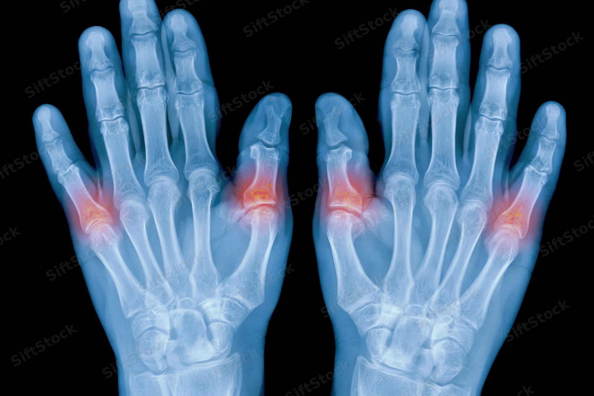 Xray of two human hands palms up showing inflamed joints in red against black background