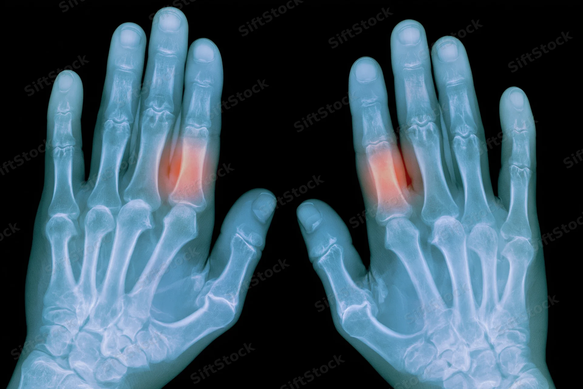 Xray of two human hands palms up showing bone structure with red highlighted areas indicating joint inflammation