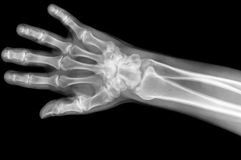 Xray radiograph of a human hand and wrist extended outward showing skeletal structure against black background